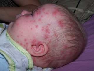 Erupção cutânea da varicela sobre a cabeça de um bebê